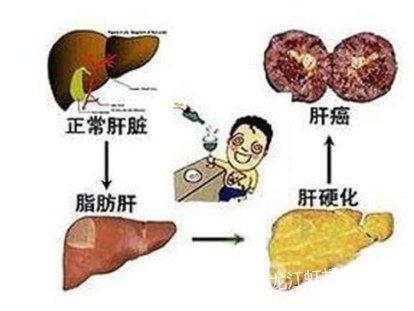 肝硬化病人口渴咋回事_肝硬化病人图片(3)